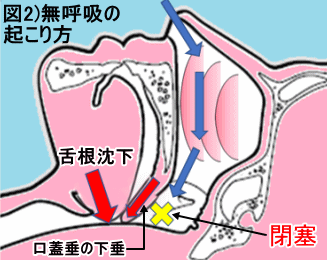 無呼吸の起こり方