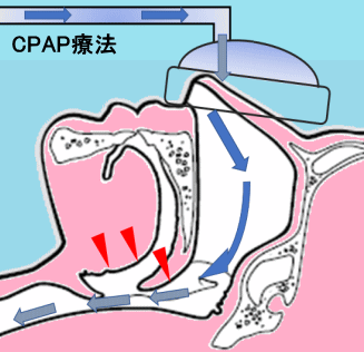 CPAP療法